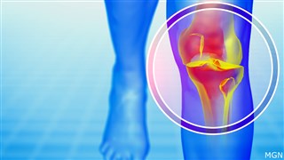 Embolización de la Arteria Genicular: Un Alivio Innovador para Rodillas